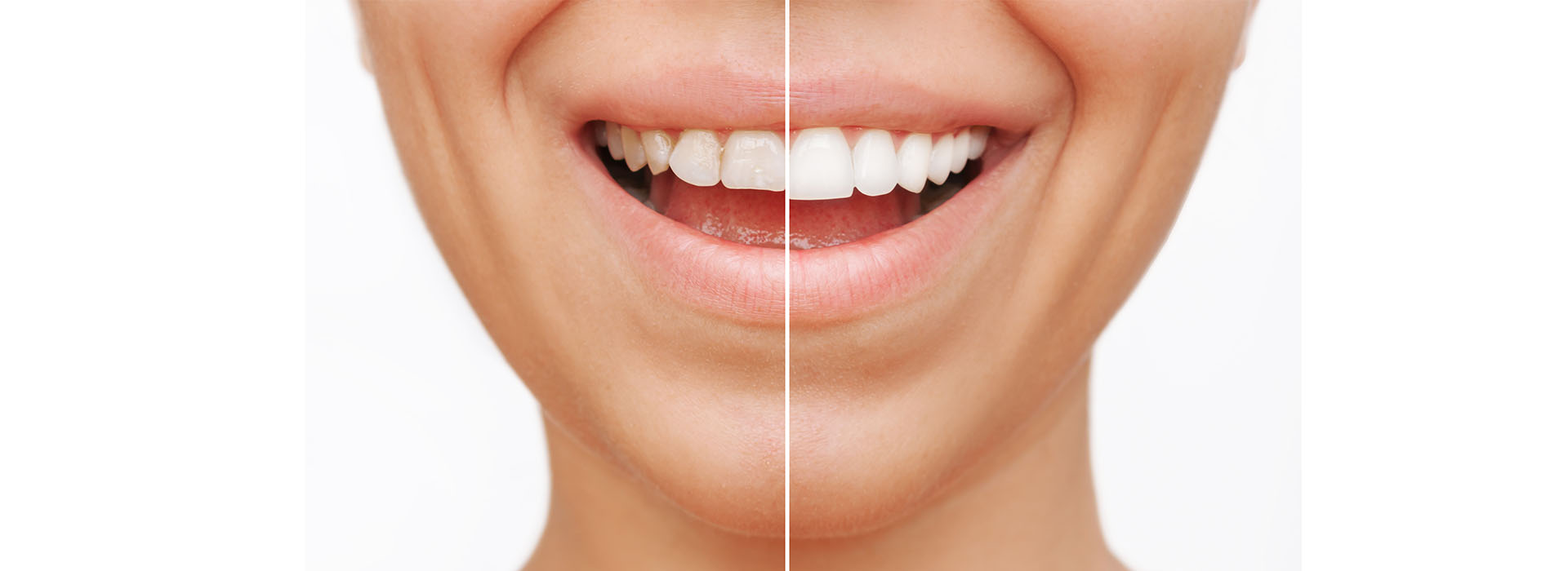 The image features a split-screen effect with two halves of a smiling face, one half showing a person's profile view and the other showing a close-up of their teeth.