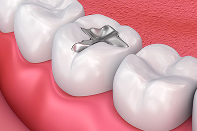 The image shows a close-up of a dental implant with a screw visible in the center, surrounded by teeth and gums.