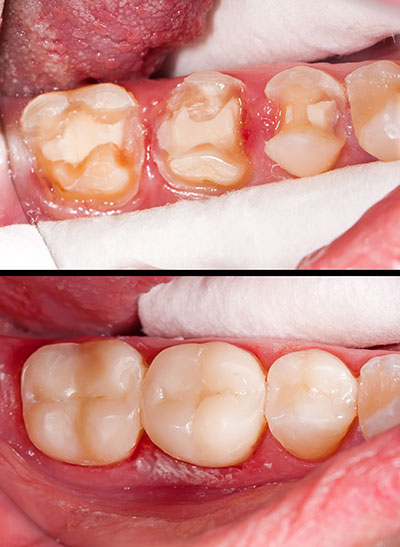The image shows a close-up of a person's teeth with significant decay and staining, emphasizing the need for dental care.
