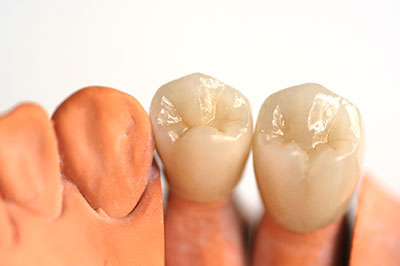 Dental implants with artificial gums displayed for educational or promotional purposes.