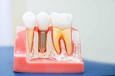 The image shows a close-up of dental prosthetics, including tooth crowns and implants, with visible screws and a pink wax model, likely used for planning or fitting purposes.