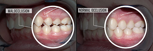 The image displays a side-by-side comparison of a person's teeth before and after dental treatment, with text labels indicating 'malocclusion' and 'normal occlusion.