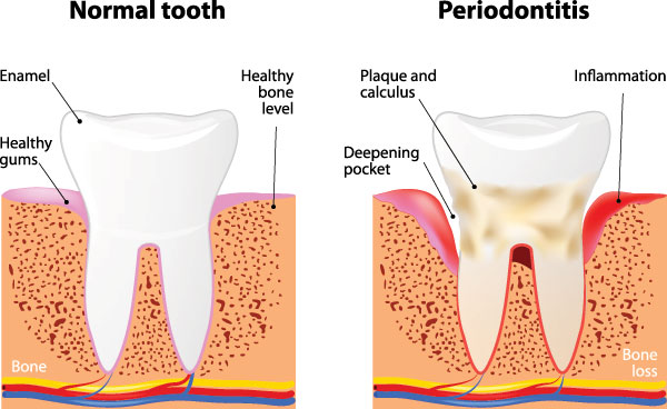The image is a medical illustration comparing normal teeth to teeth affected by periodontitis. It shows a healthy tooth on the left, with a normal level of bone and gum tissue, and a diseased tooth on the right, depicting advanced periodontitis with significant bone loss around the root.
