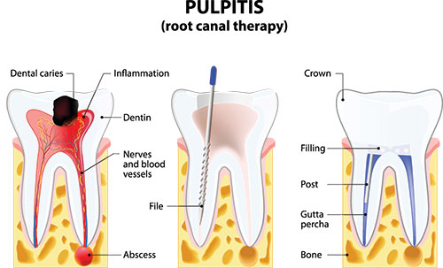 The image is a detailed illustration of the anatomy and structure of a human tooth, highlighting its various components such as the enamel, dentin, pulp cavity, and root canal therapy.