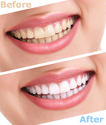 The image shows a person's teeth before and after a cosmetic dental treatment, with the text 'BEFORE' and 'AFTER' indicating the transformation.