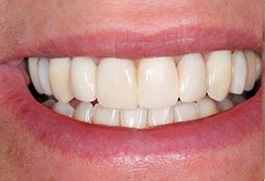 The image shows a close-up of a person's smile, displaying white teeth and pink gums.