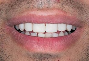 The image shows a close-up of a person's mouth with teeth, smiling at the camera.