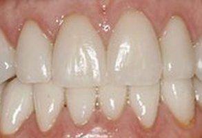 The image shows a close-up of a person's teeth with visible staining, particularly noticeable on the lower front teeth.