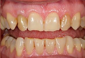 The image shows a close-up of a person's teeth, with the focus on the front teeth which are prominently displayed.